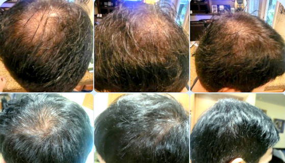 어떤 포토샵 수정도 없이 실제 사용자가 24주 동안 '헤어붐'을 사용하고 나서 찍은 이전(before)과 이후(after) 사진. [사진 와이져리빙]