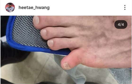 탈구된 이준환의 발가락. 사진 황희태 SNS