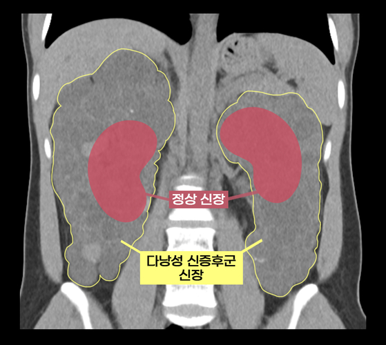 실제 다낭성 신증후군 환자의 신장과 정상 신장 비교(수많은 낭종으로 울퉁불퉁하고 크기도 비대해진 상태)