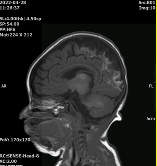 사고 발생 약 2주 뒤 찍은 민서의 뇌 MRI 사진. 사진을 감정한 의사는 ″혈류 공급이 중단되면 쉽게 손상을 받는 부위인 두정후두엽 경계 부분이 손상됐다″며 ″뇌손상의 정도는 대뇌피질이 거의 소실된 것으로 판단된다″고 했다. 사진 최씨 