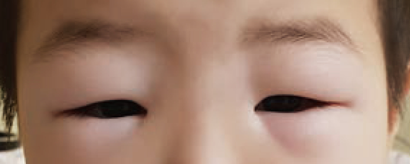 부종으로 인해 눈 주위가 부어있는 소아 신증후군 환자. 사진 대한소아신장학회, 서울대어린이병원