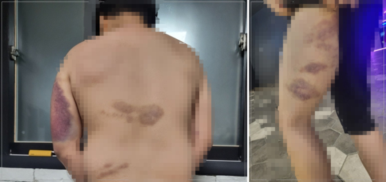 A군이 폭행당한 직후 A군의 어머니가 찍은 사진. 몸 곳곳에 시퍼렇게 피멍이 들어 있다. 사진 독자