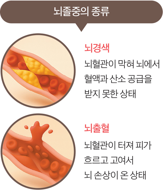 뇌졸중의 종류