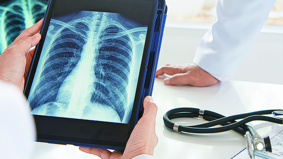  초기 증상이 거의 없는 폐암은 흉부 X선 검사와 저선량 흉부 CT를 통해 조기에 발견하는 것이 바람직하다.