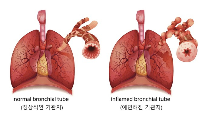 천식 환자 기관지 모습. 자료 서울대병원