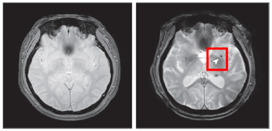 연구팀은 노화 심층조사사업 참여자 1441명을 8년 동안 추적해 수면무호흡증이 뇌 미세출혈 발생에 미치는 영향을 분석했다. 사진은 뇌 미세출혈이 발생하기 전(왼쪽)과 후 한 참여자의 뇌 영상 이미지. 사진 국립보건연구원