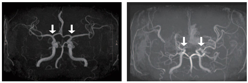일반인의 뇌혈관(왼쪽)과 모야모야병 환자 뇌혈관(오른쪽). 자료 서울대병원