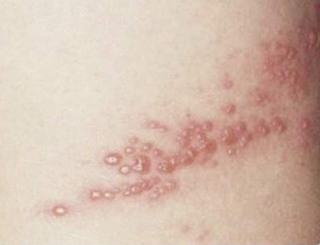 피부에 띠 모양으로 생긴 발진과 물집. 사진 대한의학회ㆍ보건복지부