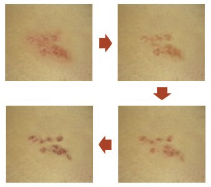 대상포진 피부 병변의 변화 양상. 사진 서울대병원