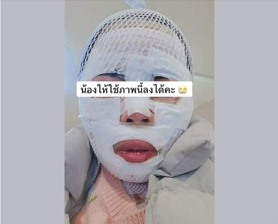 한국인 남성이 끓는 물을 얼굴에 부어 화상 입은 태국인 아내. 사진 페이스북 캡처