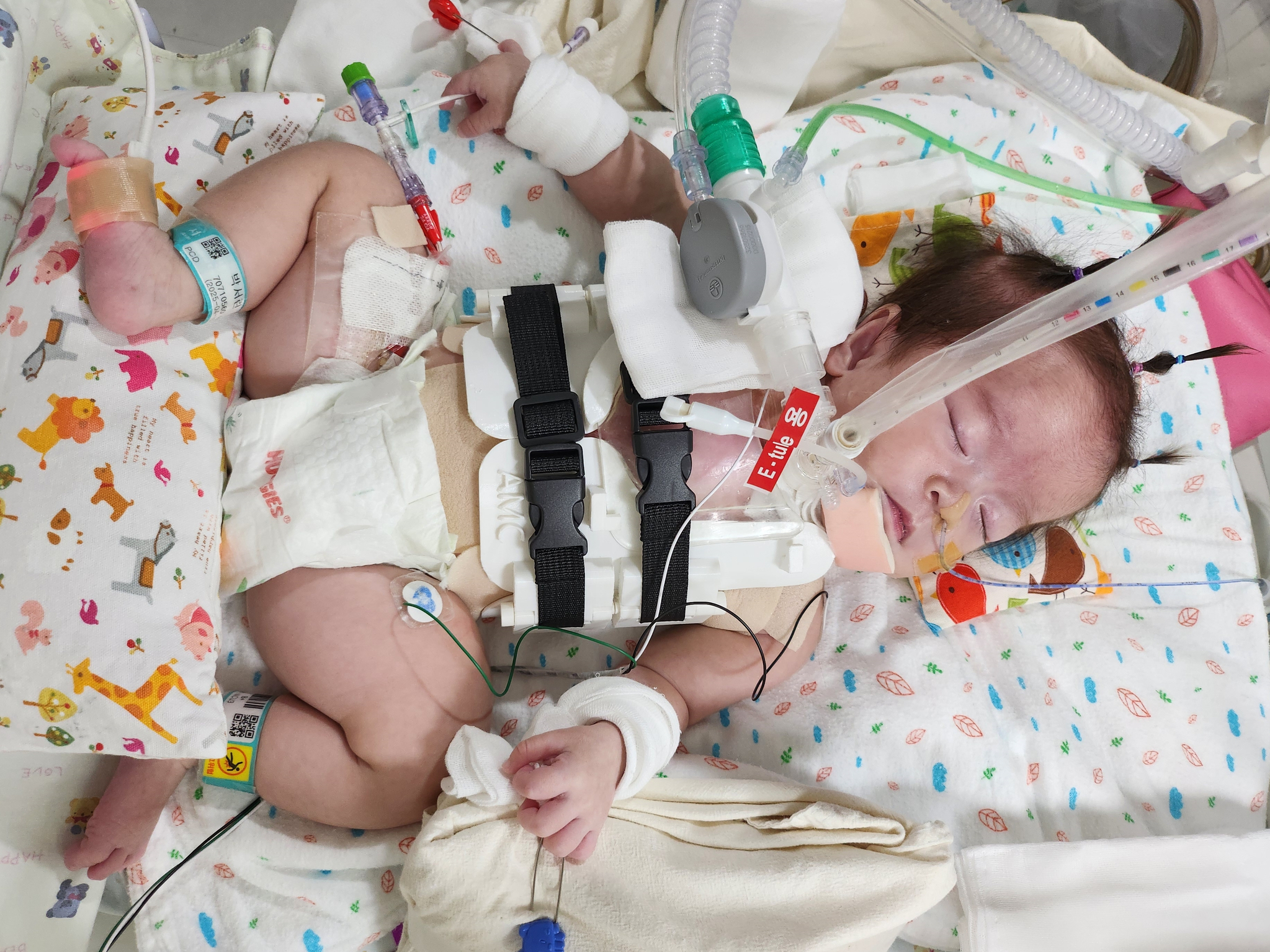 심장이소증을 안고 태어났지만, 치료 끝에 건강하게 성장한 아기 서린이. 서울아산병원
