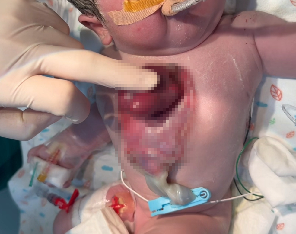 심장이소증을 안고 태어났지만, 치료 끝에 건강하게 성장한 아기 서린이의 출생 당시 가슴 모습 서울아산병원