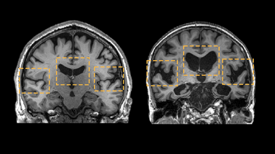 중년을 어떻게 보내느냐에 따라 당신의 뇌는 치매에 부쩍 다가설 수도 있고, 한없이 미룰 수도 있다. 치매 관리의 핵심 시기는 중년이다. 부피가 충분해 보이는 오른쪽 뇌는 정상인. 쪼그라들어 휑해 보이는 왼쪽 뇌는 알츠하이머 환자. 사진 Leonidas Chouliaras et al., 2023