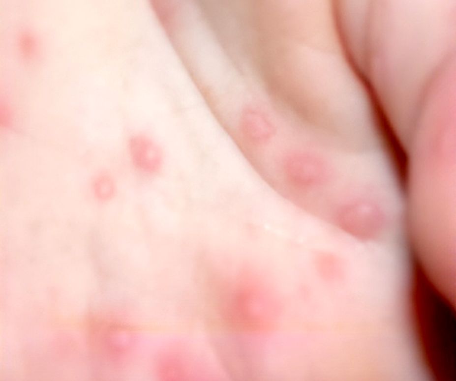 대만에서 영유아 수족구병과 신생아 패혈증 등 다양한 합병증을 유발하는 엔테로바이러스(장바이러스)가 확산하고 있다. 사진 질병관리청