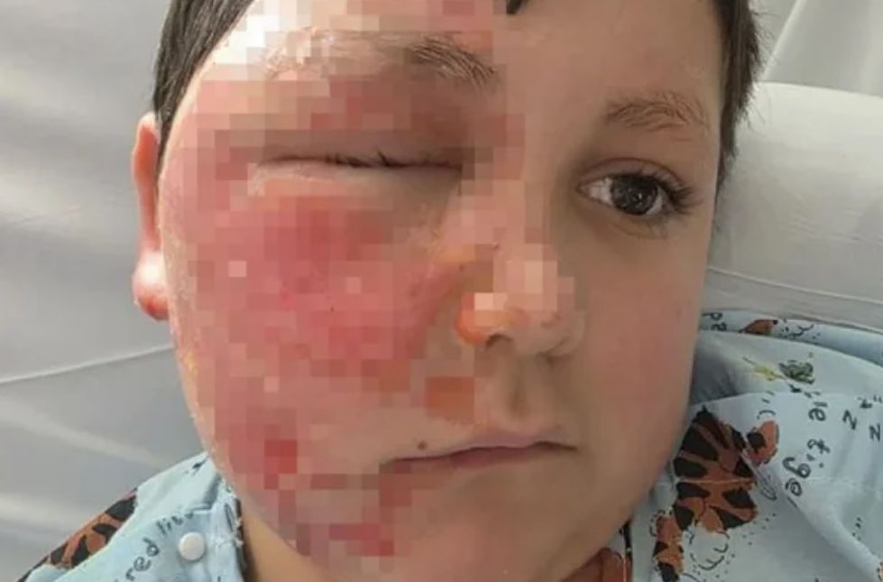 9세男 얼굴에 충격 화상…