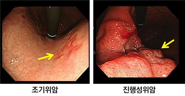 조기 위암과 진행성 위암 비교. 사진 서울아산병원