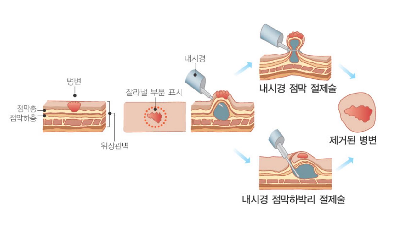 내시경 점막하 박리술 개념도. 자료 서울아산병원