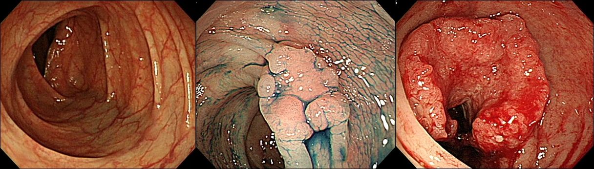 (왼쪽부터) 정상 대장 점막, 조기 대장암, 진행성 대장암 모습. 사진 서울아산병원