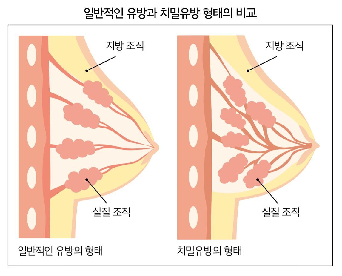 일반 유방과 치밀 유방 비교