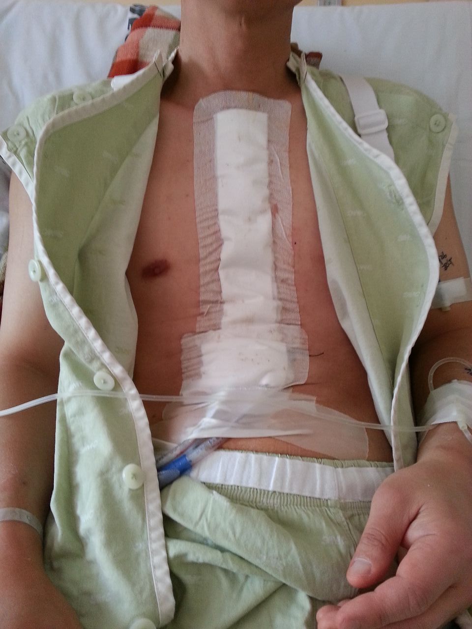 김병천 교수가 흉선암 수술을 마쳤을 때의 모습. 사진 김병천 교수 제공