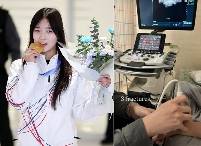 2026 밀라노·코르티나담페초 동계올림픽 스노보드 여자 하프파이프에서 금메달을 딴 최가온이 병원 검진 사진을 올렸다. 사진 연합뉴스·최가온 인스타그램 캡처