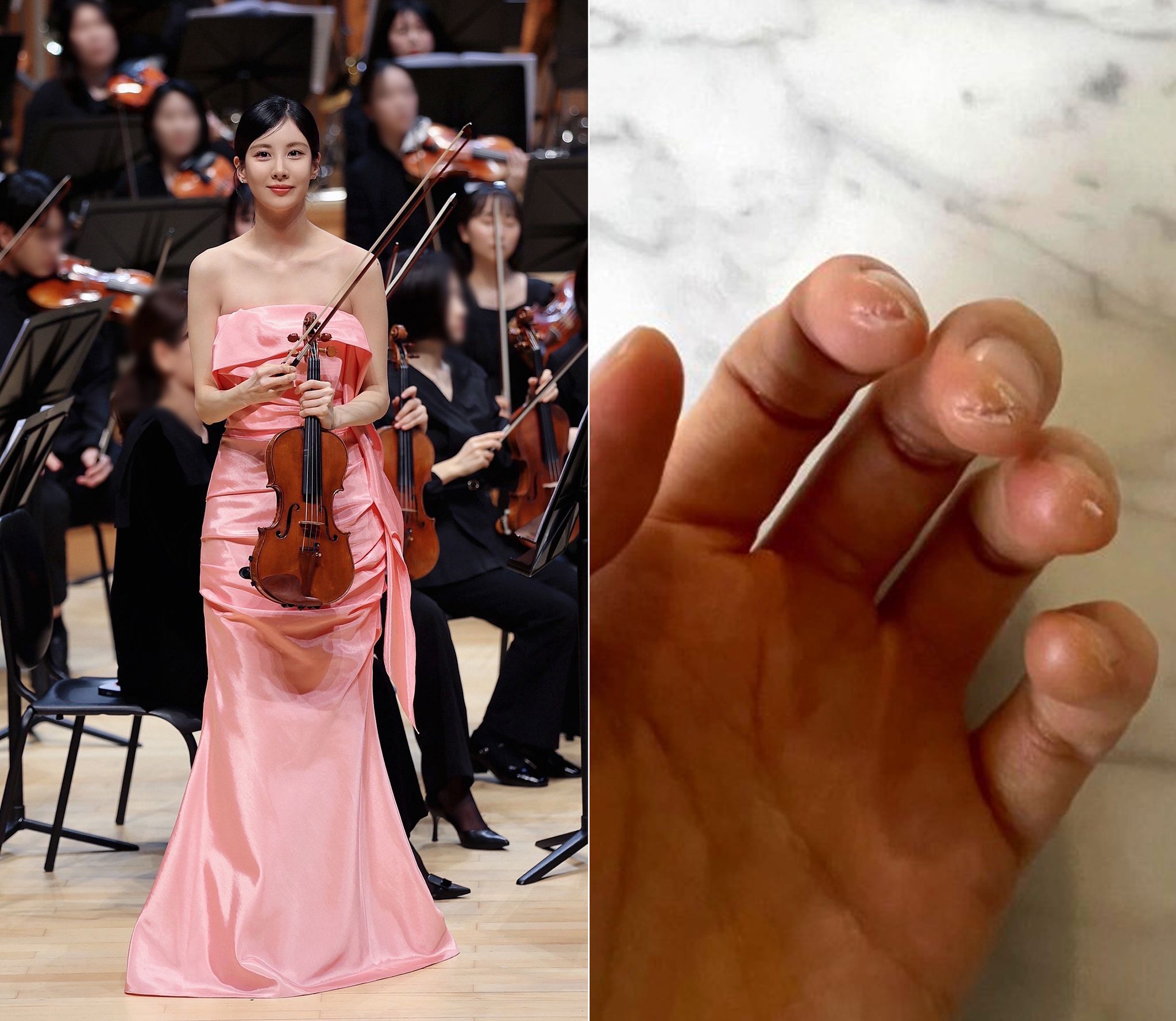 그룹 소녀시대 멤버 겸 배우 서현이 지난 13일 무대에 오른 모습(왼쪽). 오른쪽 사진은 서현의 부르튼 손. 사진 소속사·인스타그램 캡처