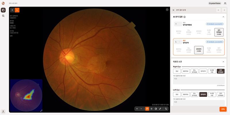 레티케어의 좌안 망막전막 검출 예시(예측점수 0.999)
