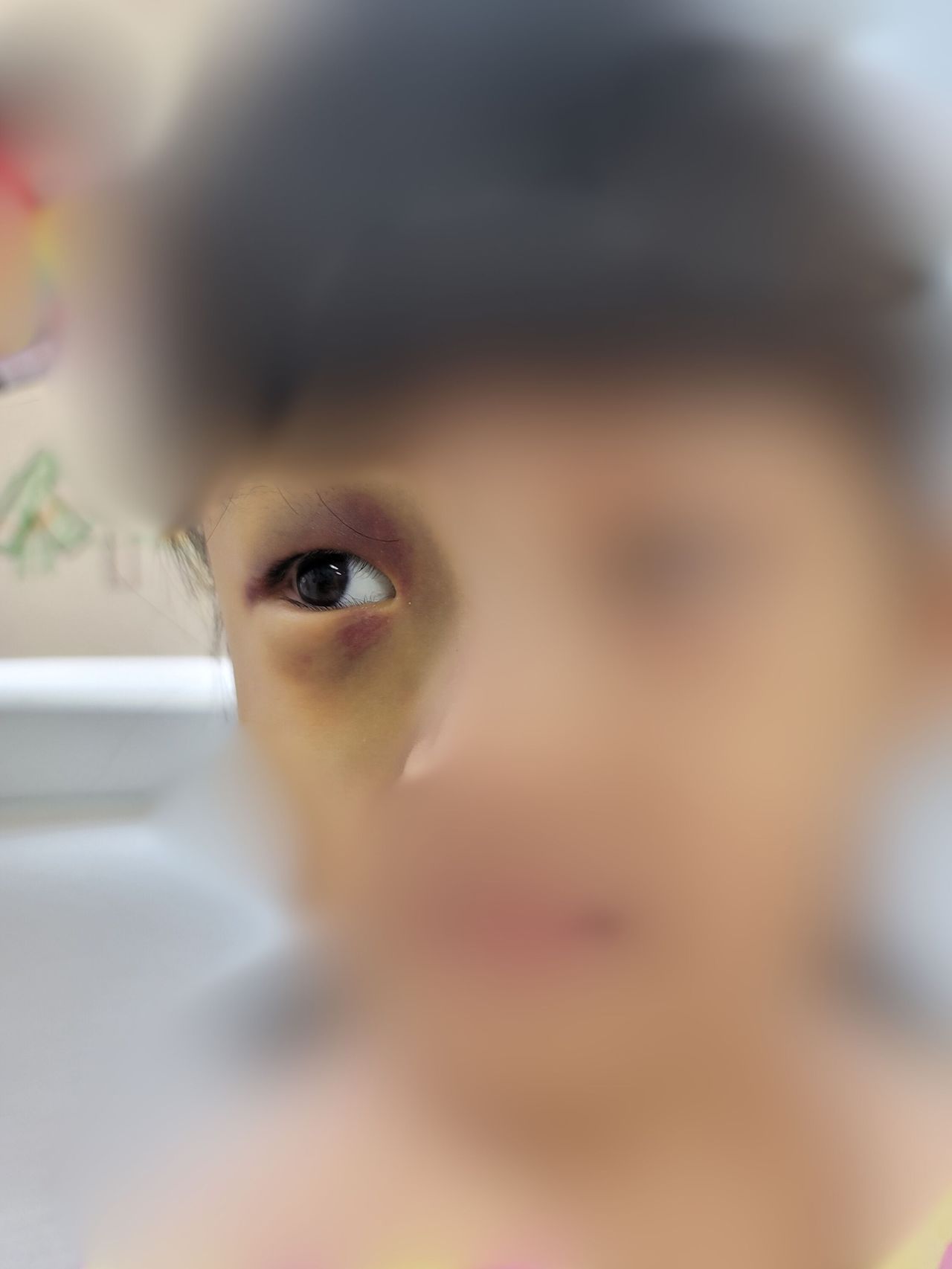 서윤(가명)이 눈가에 생긴 멍. 사진 독자