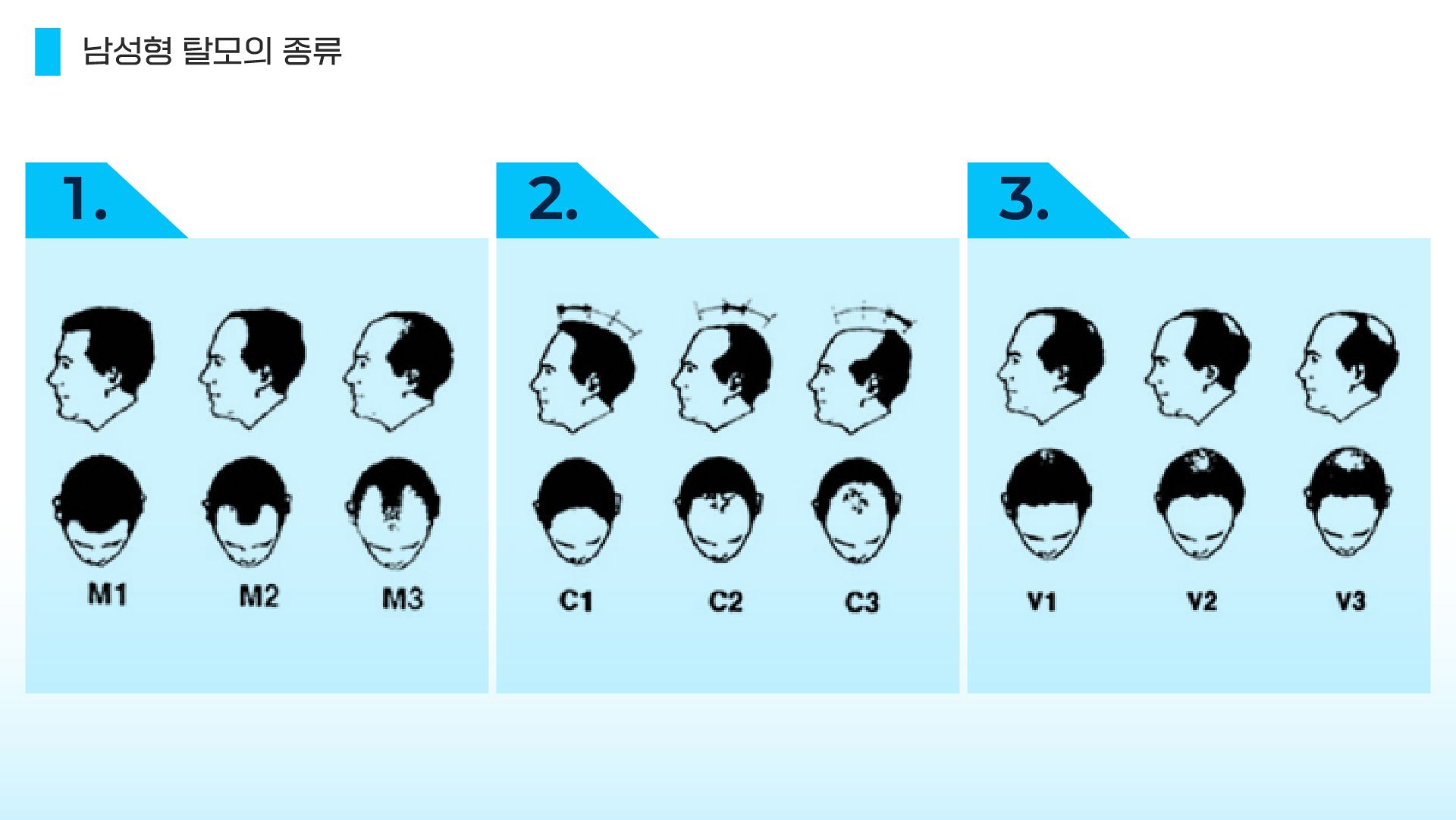 남성형 탈모의 종류. M자 타입, 이마부터 벗겨지는 타입, 정수리부터 벗겨지는 타입 등으로 크게 나눌 수 있다. 처음 굵던 머리는 3~6년 정도 자라다 다시 빠지는데, 그다음 나온 모발의 교체 주기는 이보다 짧은 1년 정도로 줄어든다. 이 과정이 반복되면서 모발이 가늘어지고 결국 솜털처럼 변하면서 탈모가 일어난다. 이민서 그래픽.