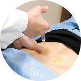 정운석 원장이 송씨 허리에 약침을 놓고 있다. [사진 울산자생한방병원]