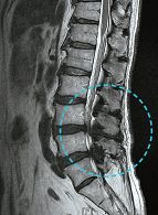 송씨의 병원 방문 당시 MRI 사진으로, 요추 4~5번, 요추 5번~꼬리뼈 1번 구간의 척추관이 협착으로 좁아져 있다. [사진 울산자생한방병원]