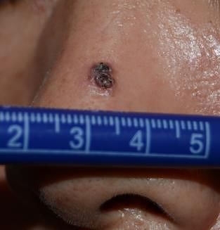코에 발생한 6mm 크기의 기저세포암