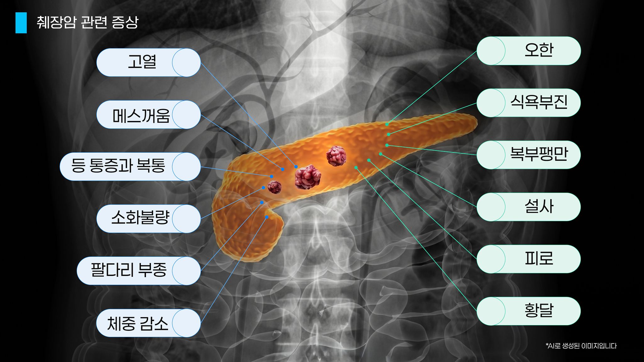 췌장암은 초기에 증상이 거의 나타나지 않는다. 증상이 나타나면 병이 상당히 진행됐을 때가 많다. 그래픽 이민서.