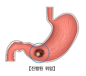 진행된 위암 모습. 자료 서울아산병원