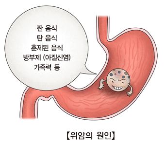 위암의 원인 설명. 자료 서울아산병원