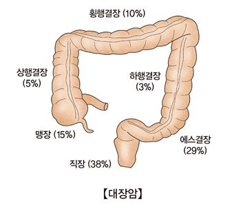 대장암이 생기는 위치. 자료 서울아산병원