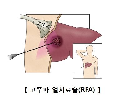 간암 고주파열치료술 설명. 자료 서울아산병원