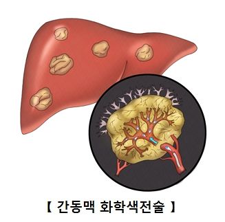 간동맥화학색전술 설명. 자료 서울아산병원