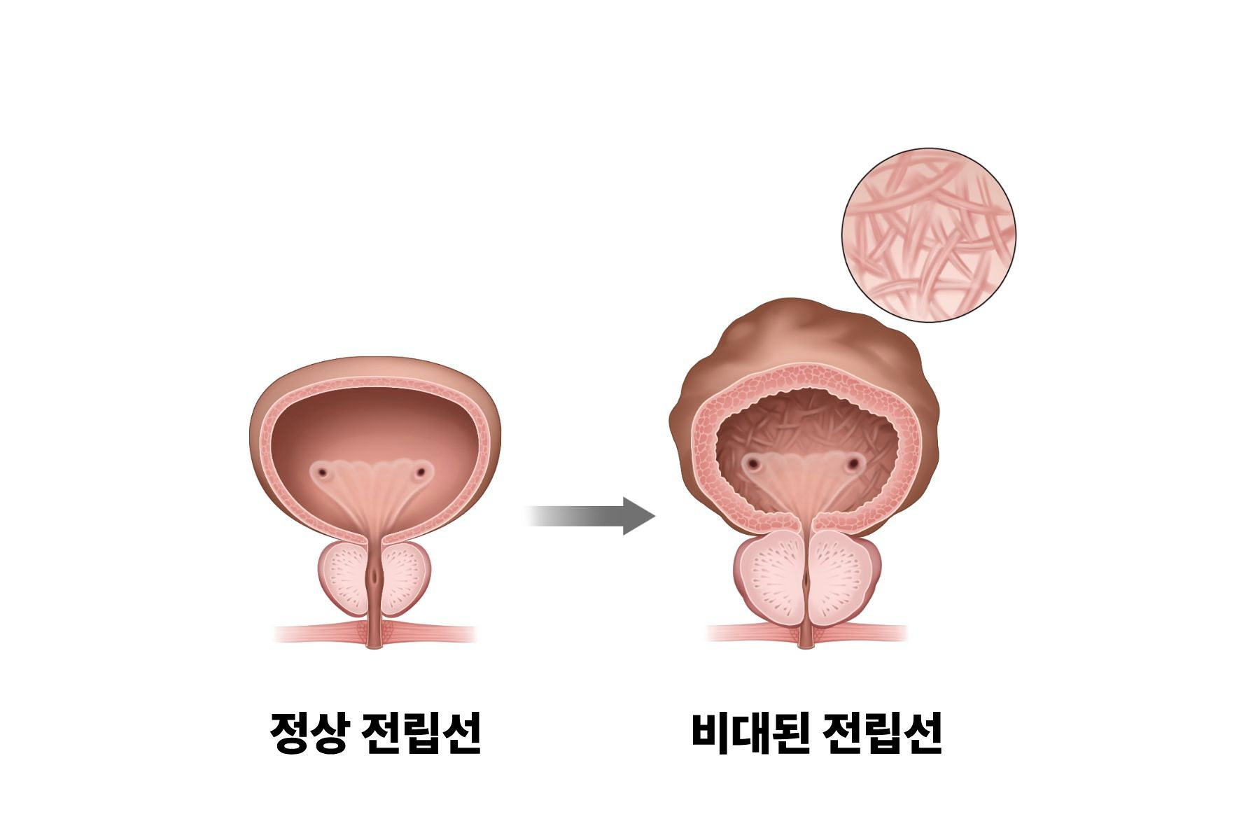 전립선 비대증 설명. 자료 서울아산병원
