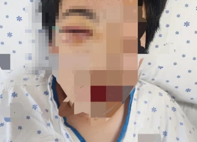 학교폭력을 당한 피해자는 안와골절로 병원에 입원한 상태다. 사진 온라인커뮤니티