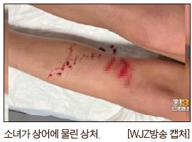 소녀가 상어에 물린 상처. [WJZ방송 캡처] 
