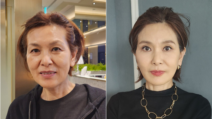 환자 전/후 비교사진. [사진 엘리트성형외과] 