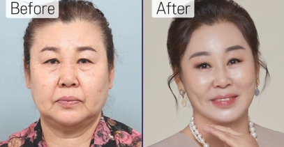 엘리스 성형외과에서 새로운 인생을 찾았다는 환자 시술 전후 모습. [엘리트 성형외과 제공]