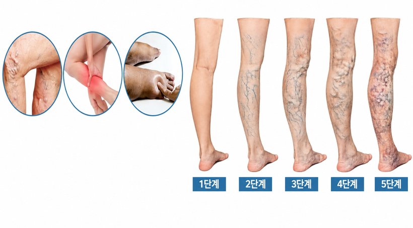 하지정맥혈관 전문병원