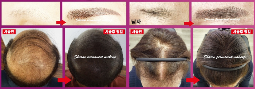 27년 경력의 샤론 여 원장이 직접 시술한 자연눈썹과 탈모 커버(SMP) 전후 모습.