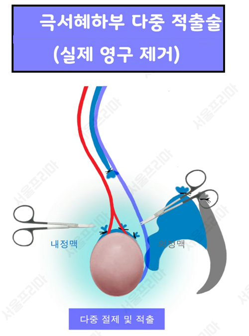 [이미지 제공 : 서울프리마비뇨기과]