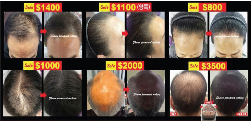 탈모 고민을 위한 시술로 최대 80%의 할인 혜택이 제공되어 단기간에 안정적인 탈모 커버 효과를 볼 수 있다.