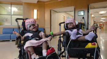 머리가 붙은 채 태어난 쌍둥이 자매 히얍과 우흐브토. [SSM Health Cardinal Glennon Children’s Hospital/ABC7 캡쳐]